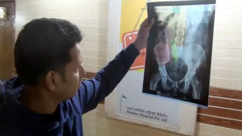 এক্স-রে মেশিনে তরুণের পেটে ধরা পড়লো ২ হাজার পিস ইয়াবা